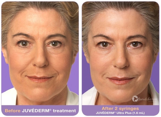 JUVÉDERM Before and After 2