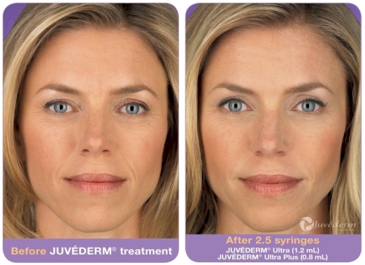 JUVÉDERM Before and After 3