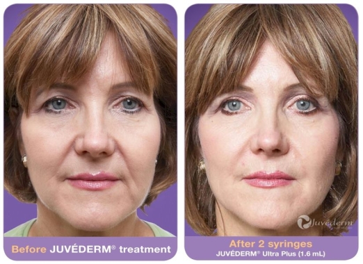 JUVÉDERM Before and After 4