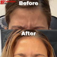 Botox San Marcos Before & After