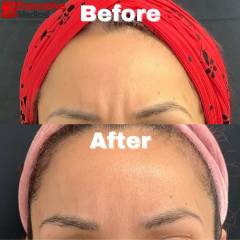 Botox San Marcos Before & After